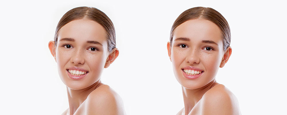 Kepçe Kulak Estetiği (Otoplasti)